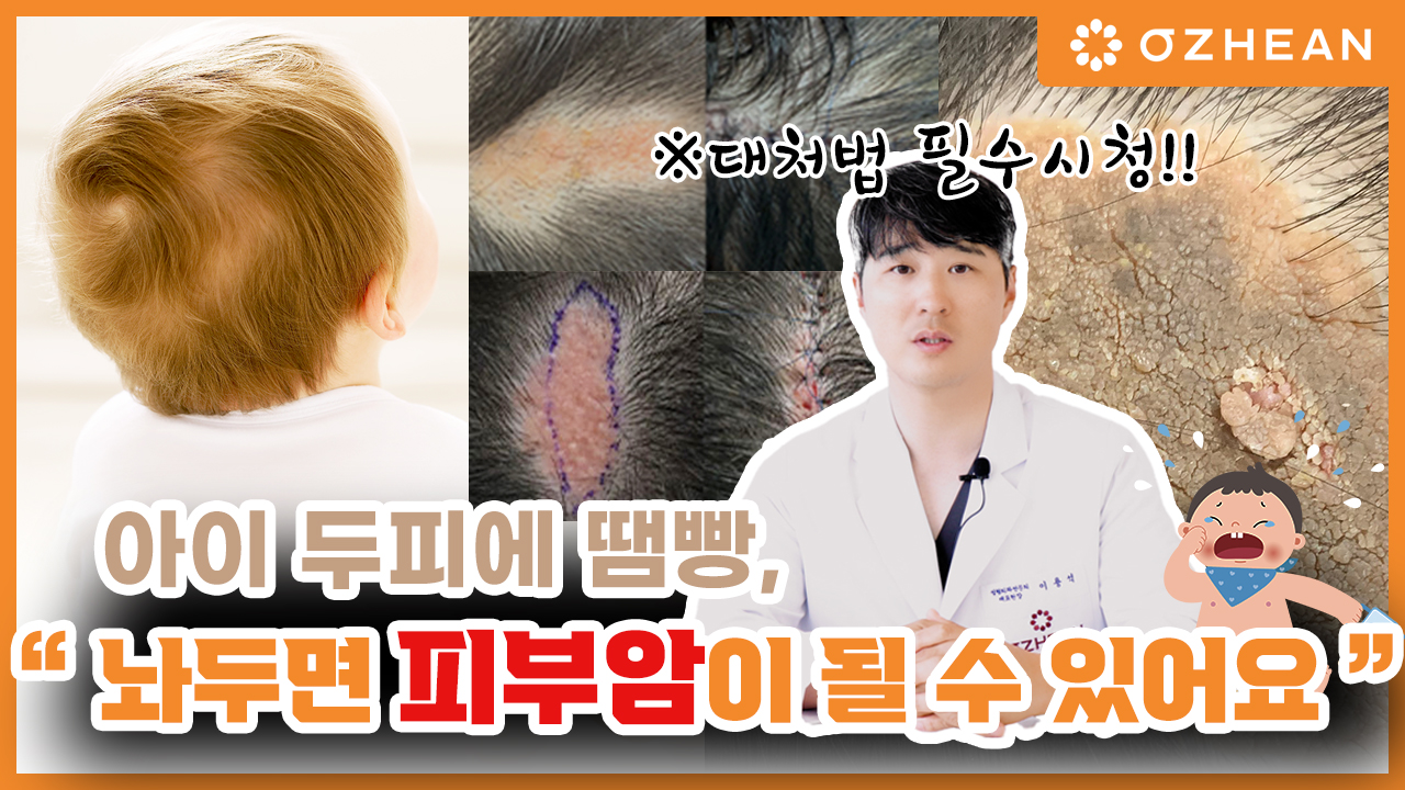 피지샘 모반이 피부암이 될 수 있다고? ㅣ 초기에 제거해야 하는 이유 ㅣ 두피 혹 ㅣ 아이 탈모 ㅣ 선천성 모반 오체안 뉴스 썸네일