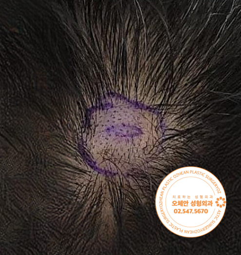 머리 정수리 혹, 탈모처럼 보일 수도 ...