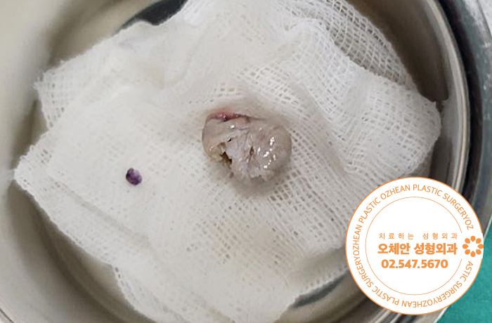 허벅지 멍울 피지낭종 염증 생기기 전에 성형외과전문의만나 제거해요!