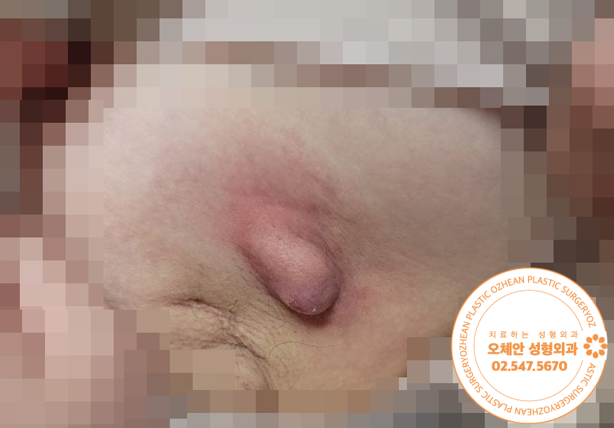 겨드랑이 통증과 발적 생긴 표피낭종 치료