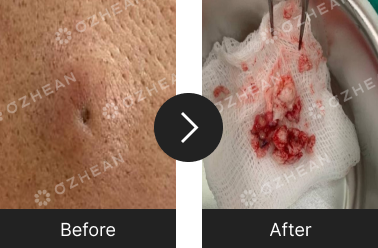 얼굴, 볼 멍울 제거 수술 오체안 전후사진 썸네일