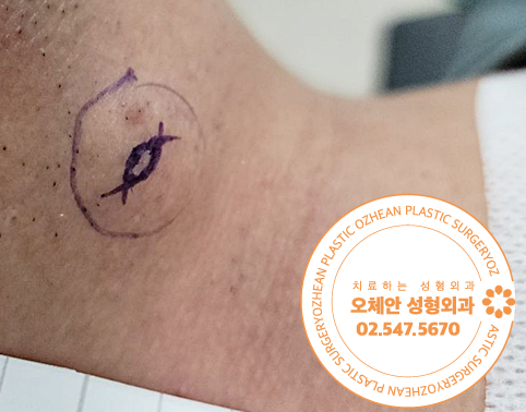 목 주변에 덩어리가 만져져요 어떤 질환...