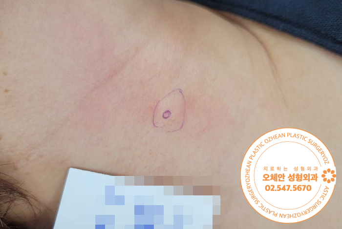 목뒤 피지낭종 곪아 커지기 전에 외과적 수술로 제거!