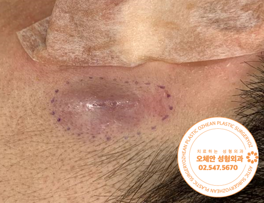 귀 앞 표피낭종 염증 수술로 제거해요 
