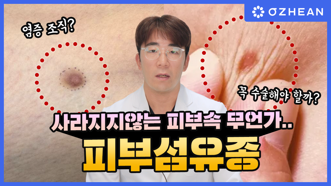 피부 속 딱딱한 무언가 만져진다면? 피부섬유종의 모든 것! 오체안 뉴스 썸네일