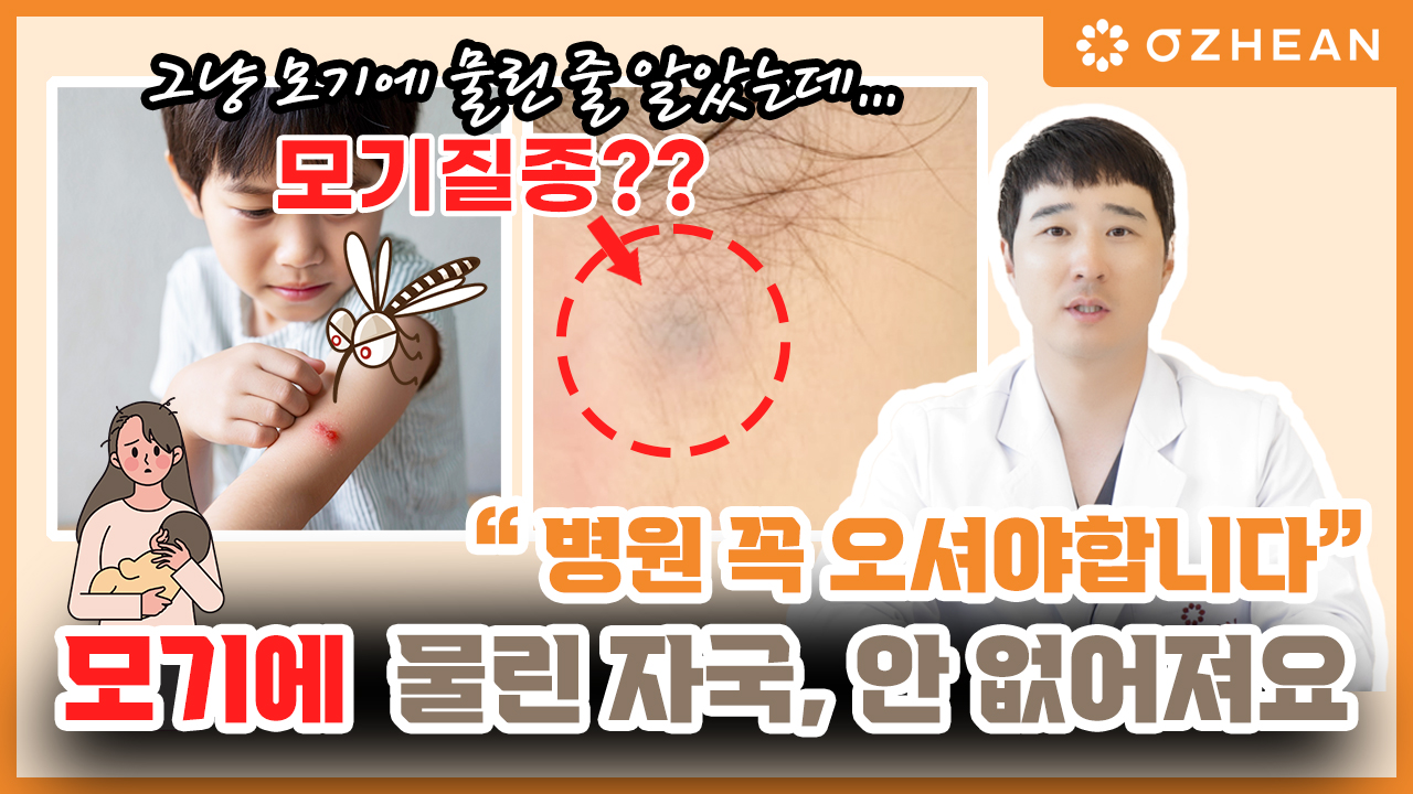 모기 물린 줄 알았는데… 알고 보니 ‘모기질종’? ㅣ 초기에 병원 가야하는 이유 ㅣ #모기질종 #붉은흉터 #붉은상처 #모기물림 #뾰루지 오체안 뉴스 썸네일