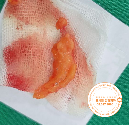 왼쪽 어깨 지방종, 통증 없다고 방치해...