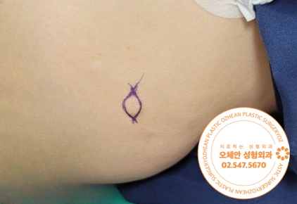 겨드랑이 지방종 수술적 방법으로 제거해요 