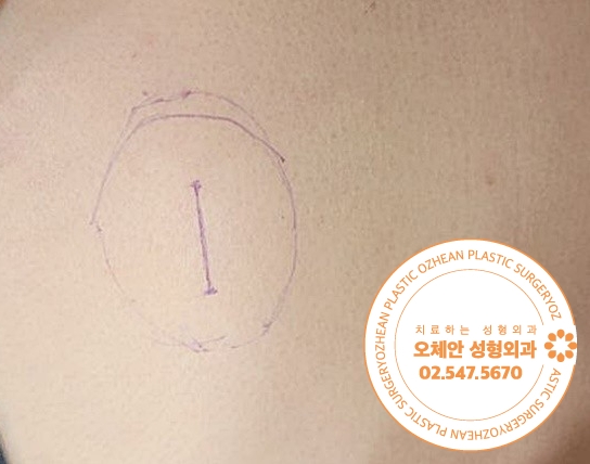 등 지방종 크기 및 위치에 따라 신체움...