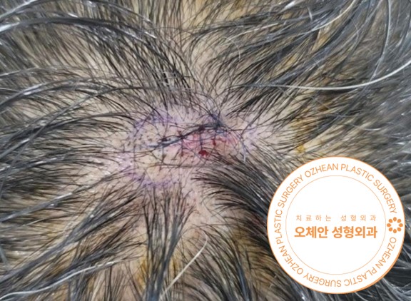 대전 머리 혹 양성종양 재발률 낮추는 수술적 방법으로 치료해요