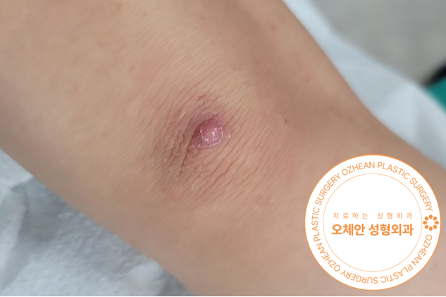 팔꿈치 혹 피지낭종 제거 수술 부담을 덜고 싶다면?