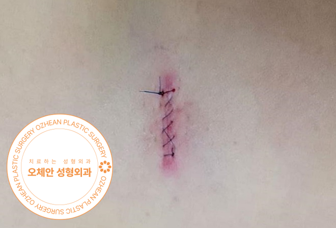대전 피부지방종 제거 전 초음파 검사 이유 
