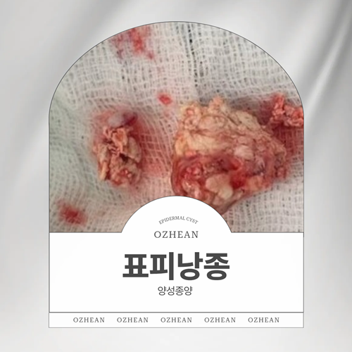 대전 표피낭종, 피부 속 작은 멍울이 사라지지 않는다면?