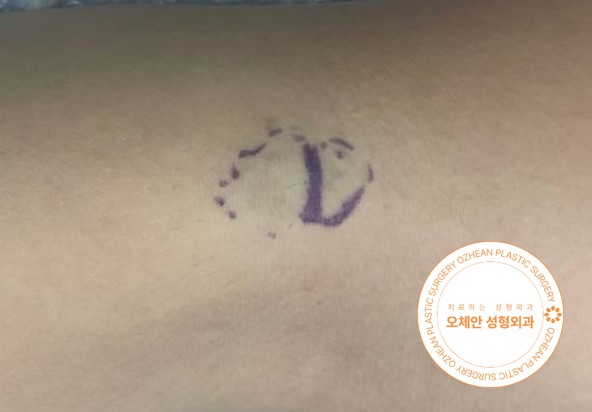 팔 모기질종 원인과 제거 방법