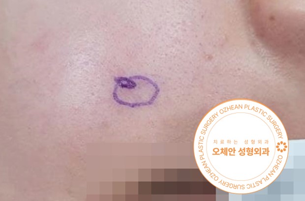 피지낭종 제거 방법과 수술 후 관리