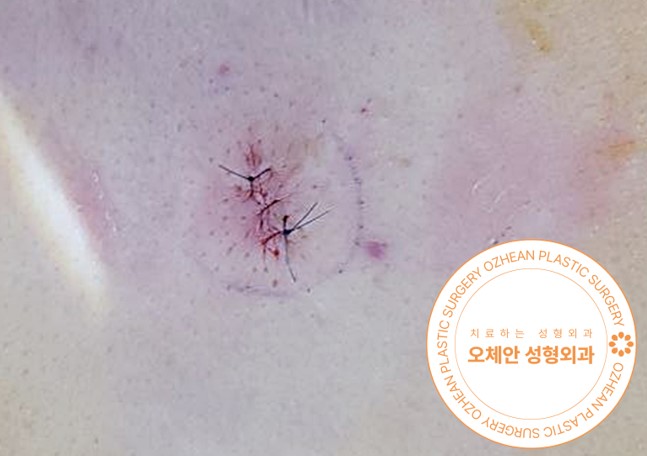 배에 혹 이런 상태라면 빠른 수술 필요해요!