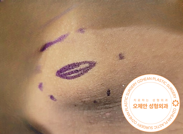 표피낭종 재발을 줄이는 수술 방법