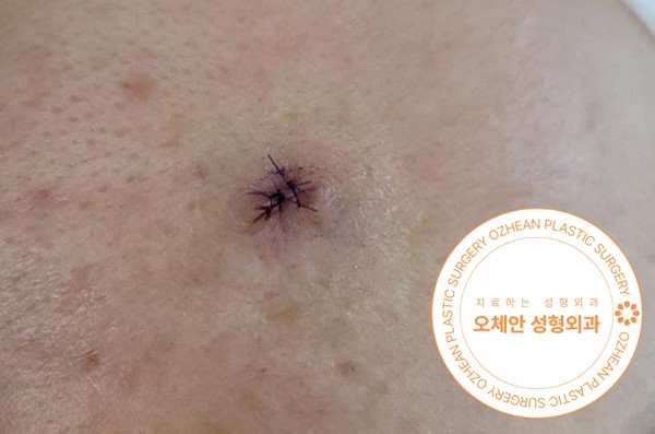 어깨 혹 종양 통증 생기기 전 제거해요 
