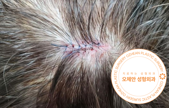 두피 표피낭종 너무 커지고 염증 생기기 전 제거해요