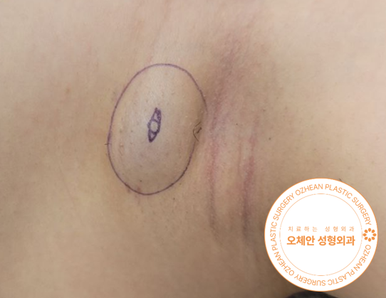 겨드랑이 표피낭종 방치하면 계속 커지고 염증생기기 쉬워요 