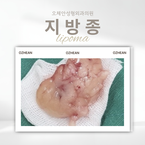대전 지방종 피부 아래 만져지는 혹의 특징과 제거 방법