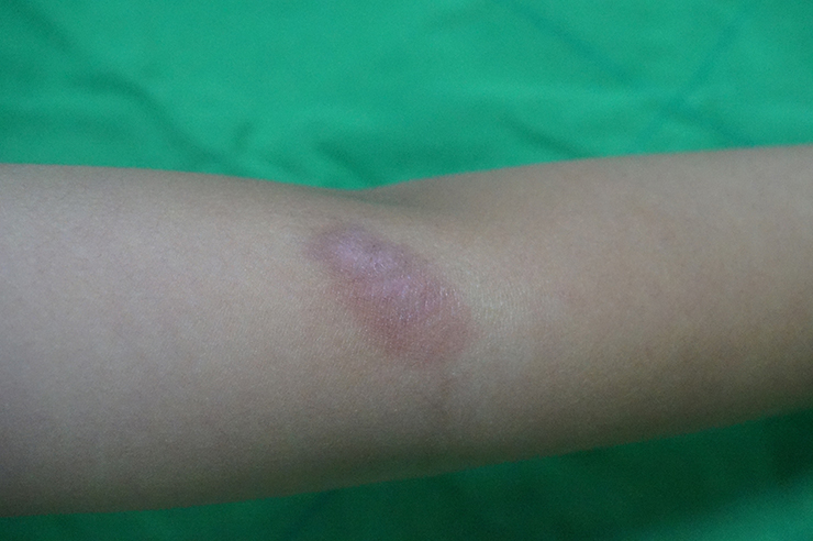 [Q&A] 흉터, 정말 완벽하게 없앨 수 있나요? 오체안피부과 전문의 답변