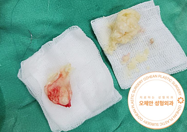 목에 작은 혹이 만져진다면?
