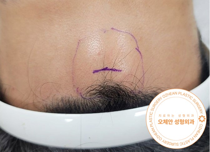 머리 혹 통증 없다가 생겼어요! ‘지방종이 근육을 누를 때 나타나는 증상’