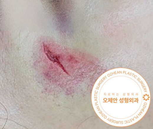 살 찢어졌을때 성형외과전문의 상주하는 곳으로!