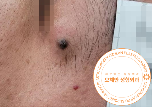 눈 주변 혹 통증 발생하였다면