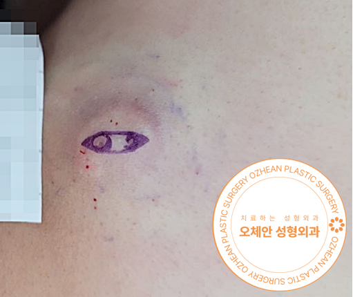 피부낭종, 왜 조기에 치료하는 것이 중요할까요?