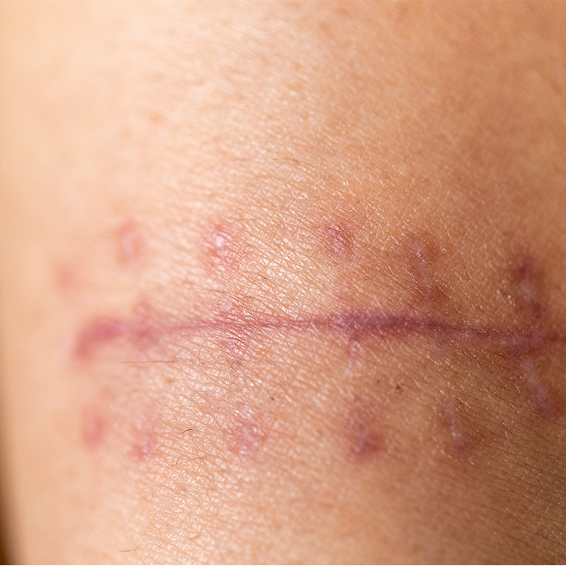 수술 흉터 안 남게 하는 법