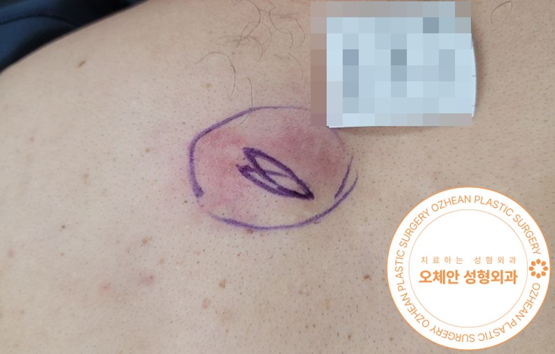 허벅지 멍울 부위가 붉어진다면? 염증반응! 즉시 치료하세요!