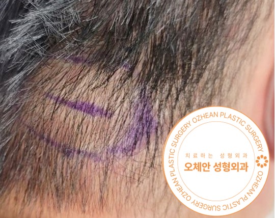 머리 혹 병원 두피 부위에도 생길 수 있는 지방종 원인은?