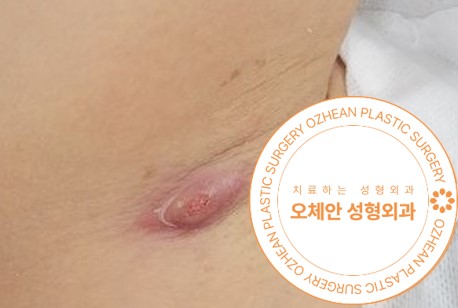 겨드랑이 염증 원인 표피낭종 치료는 수술로 