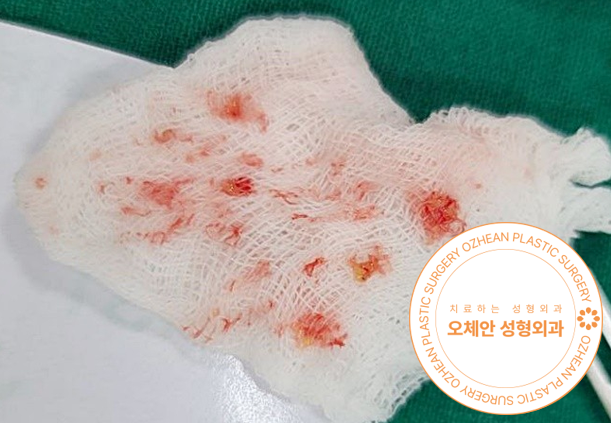 피지낭종 수술 후 관리 방법 까다롭지 않아요!