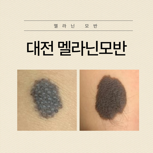 대전 멜라닌 모반 크고 돌출된 점 제거 방법