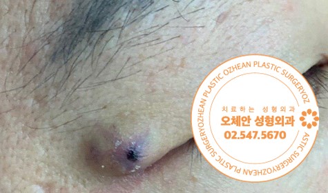 눈가 종양 없어지지 않는 표피낭종이라면...