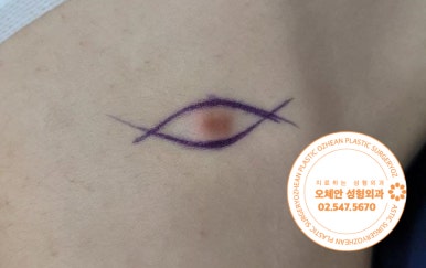 종아리 피부섬유종 조기 제거로 흉 줄여요 