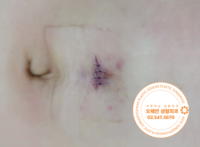 복부 혹 표피낭종 염증 발생 전에 제거...
