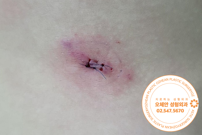 옆구리 표피낭종 염증으로 통증 생겼다면