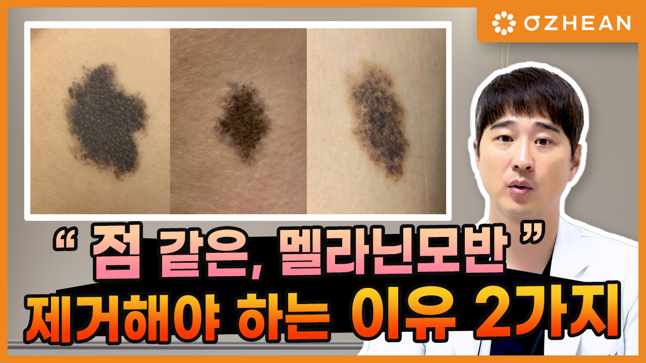 ※그냥 점 아닙니다※ ㅣ제거 해야 될까요? ㅣ 점이 보내는 위험 신호! ㅣ #멜라닌모반 #모반 #점 오체안 뉴스 썸네일