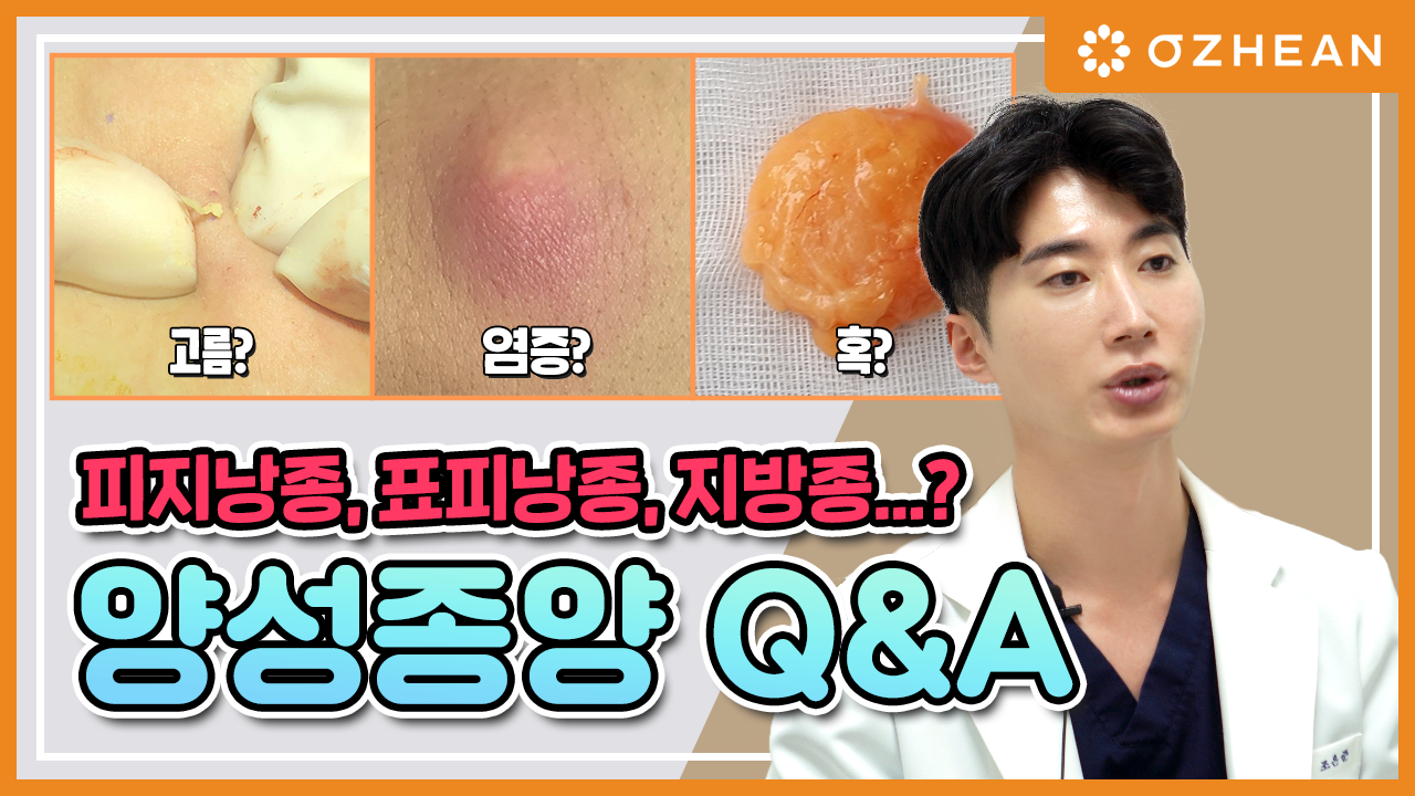 내 몸에 고름. 종기.염증이 나타났다고? 수술해야 할까? 양성종양(피지낭종, 표피낭종, 지방종, 섬유종 등) 오체안 뉴스 썸네일
